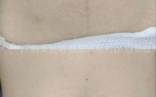 孕妇肚子上长毛正常吗_怎么去除