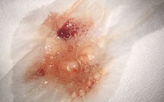 孕妇呕吐出血有危险吗_孕吐带血怎么办