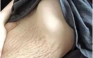 孕妇胸上长妊娠纹图片_胸部长妊娠纹怎么办