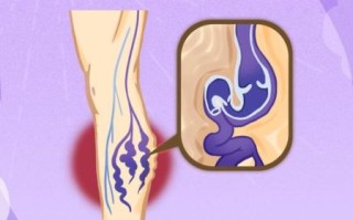 孕妇大腿有紫色血丝怎么办_怀孕静脉曲张怎么缓解