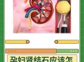 孕妇结石怎么办_孕妇结石对胎儿有影响吗