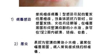 孕妇嘴角长疱疹怎么办_会影响胎儿吗