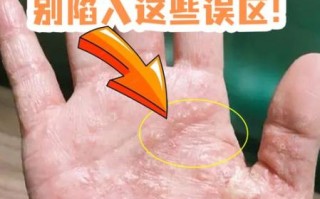 孕妇汗疱疹怎么治疗_孕期汗疱疹会自愈吗