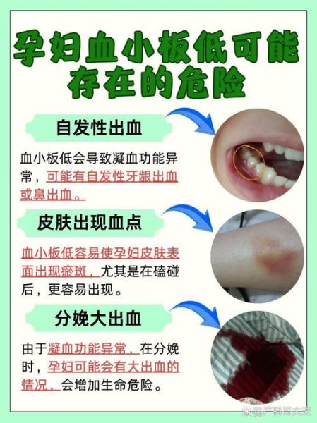 孕妇血小板低能顺产吗_血小板低顺产风险-第1张图片-星辰妙记