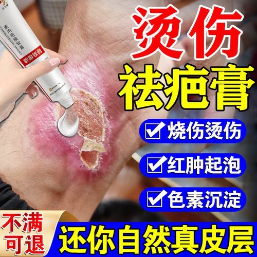 孕妇可以用烫伤药膏吗_孕妇烫伤后用什么药安全-第2张图片-星辰妙记