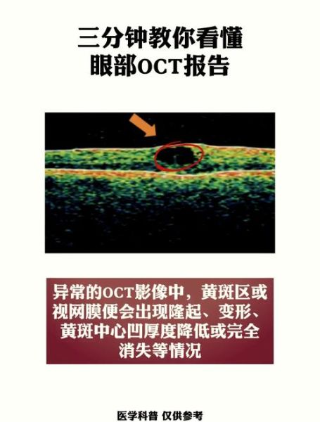 孕妇做OCT多少钱_OCT检查费用明细-第2张图片-星辰妙记