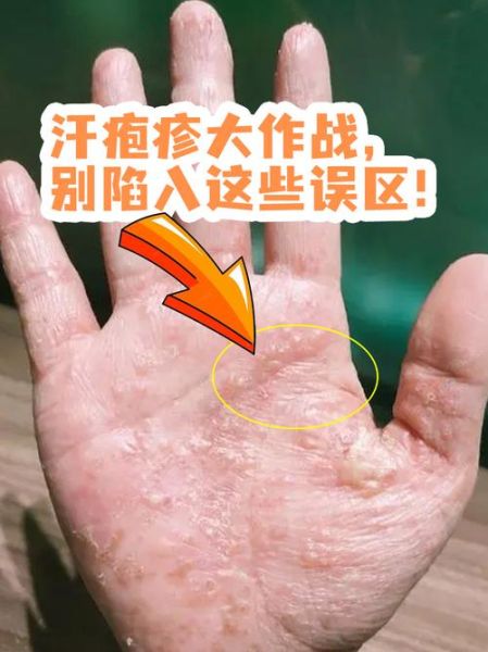 孕妇汗疱疹怎么治疗_孕期汗疱疹会自愈吗-第1张图片-星辰妙记