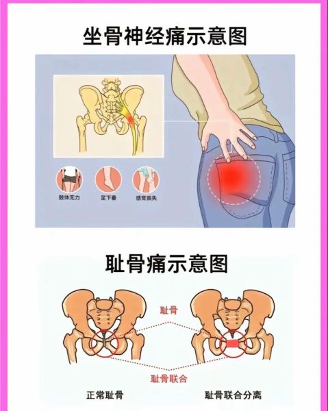 孕妇屁股疼怎么办_孕晚期屁股疼怎么缓解-第2张图片-星辰妙记