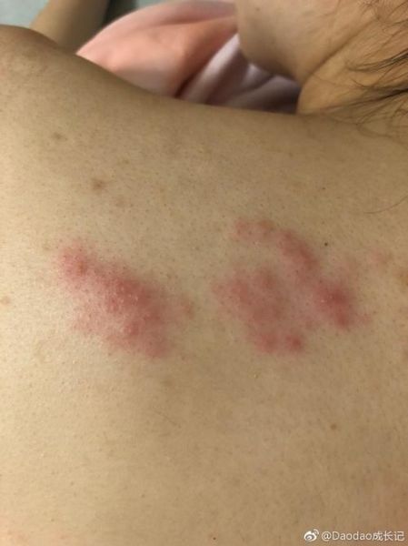 孕妇带状疱疹图片_对胎儿有影响吗-第3张图片-星辰妙记