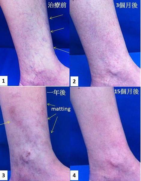 孕妇大腿有紫色血丝怎么办_怀孕静脉曲张怎么缓解-第2张图片-星辰妙记