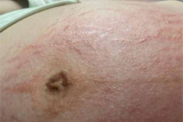 孕妇胆汁淤积能治好吗_对胎儿影响大吗-第3张图片-星辰妙记