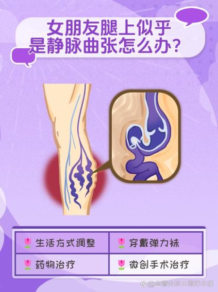 孕妇大腿有紫色血丝怎么办_怀孕静脉曲张怎么缓解-第1张图片-星辰妙记