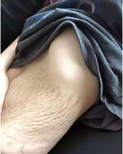 孕妇胸上长妊娠纹图片_胸部长妊娠纹怎么办-第1张图片-星辰妙记