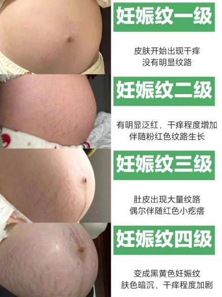 孕妇纹怎么消除_孕妇纹什么时候开始出现-第3张图片-星辰妙记