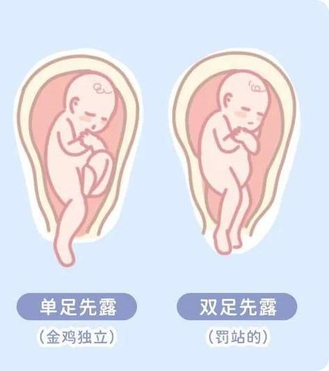 孕妇LOA胎位是什么意思_LOA胎位顺产几率大吗-第2张图片-星辰妙记