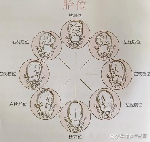 孕妇LOA胎位是什么意思_LOA胎位顺产几率大吗-第1张图片-星辰妙记