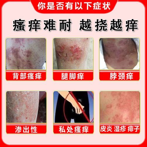 孕妇能用炉甘石洗剂吗_孕期皮肤痒怎么办-第2张图片-星辰妙记