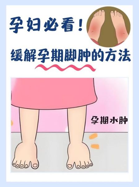 孕妇血糖高脚会肿吗_脚肿与血糖关系-第1张图片-星辰妙记