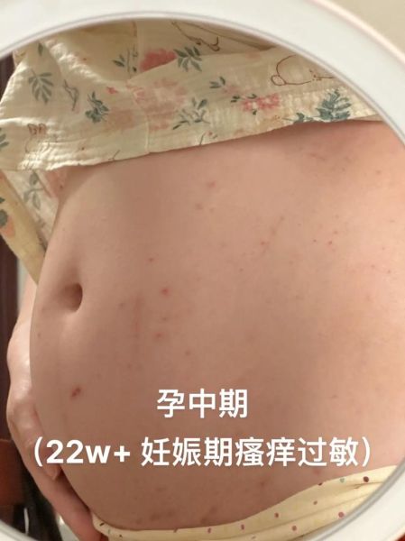 孕妇胆汁淤积是哪里痒_胆汁淤积瘙痒部位图解-第1张图片-星辰妙记