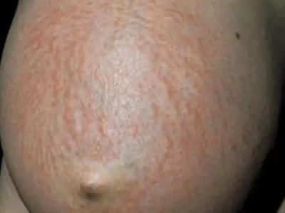孕妇肚子上起了好多小红点_对胎儿有影响吗-第1张图片-星辰妙记 孕妇肚子上起了好多小红点_对胎儿有影响吗-第1张图片-星辰妙记