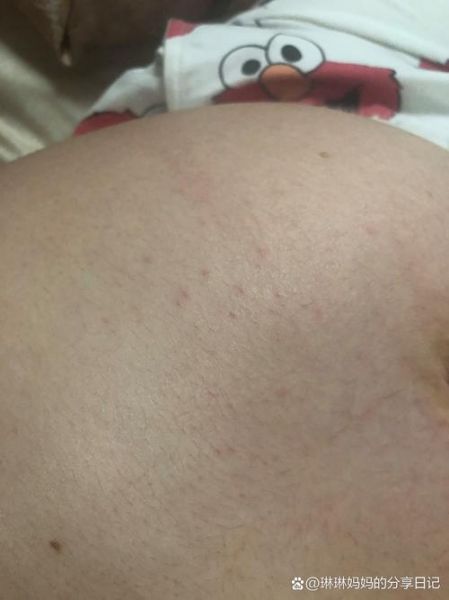 孕妇肚子上起了好多小红点_对胎儿有影响吗-第2张图片-星辰妙记 孕妇肚子上起了好多小红点_对胎儿有影响吗-第2张图片-星辰妙记