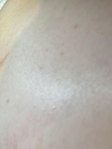 孕妇肚子上起了好多小红点_对胎儿有影响吗-第3张图片-星辰妙记 孕妇肚子上起了好多小红点_对胎儿有影响吗-第3张图片-星辰妙记