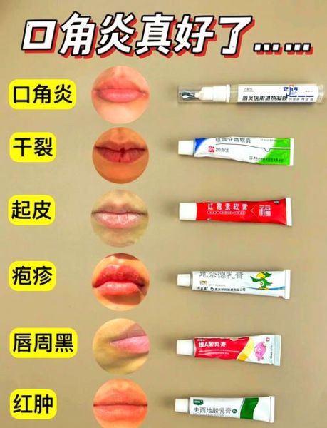 孕妇嘴角长疱疹怎么办_会影响胎儿吗-第3张图片-星辰妙记 孕妇嘴角长疱疹怎么办_会影响胎儿吗-第3张图片-星辰妙记