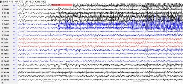孕妇能做脑电图吗_对胎儿有影响吗-第3张图片-星辰妙记