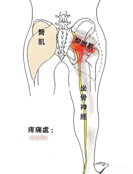 孕妇屁股疼是怎么回事_如何缓解孕晚期臀部酸痛-第2张图片-星辰妙记