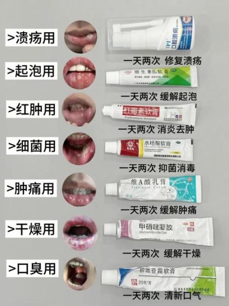 孕妇口腔溃疡能用什么药_孕期口腔溃疡安全用药指南-第1张图片-星辰妙记