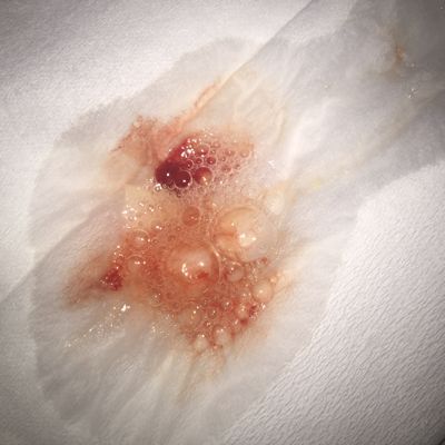 孕妇呕吐出血有危险吗_孕吐带血怎么办-第1张图片-星辰妙记