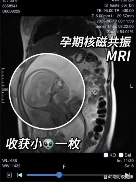 孕妇可以做核磁共振吗_对胎儿有影响吗-第1张图片-星辰妙记