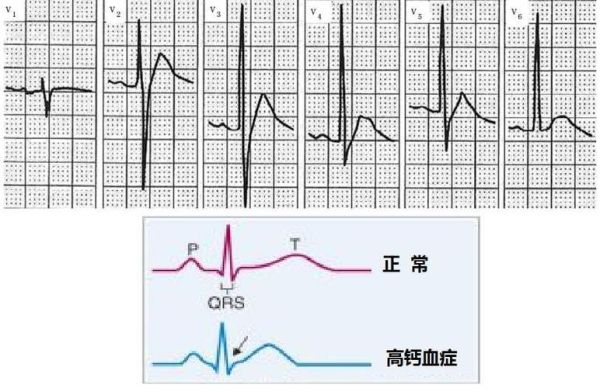 孕妇st段改变严重吗_st段压低对胎儿有影响吗-第3张图片-星辰妙记
