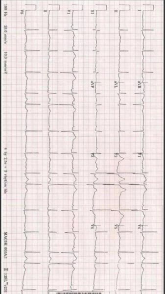 孕妇st段改变严重吗_st段压低对胎儿有影响吗-第2张图片-星辰妙记