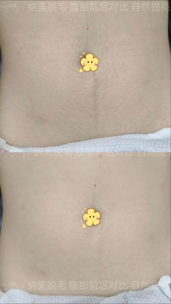 孕妇肚子上长毛正常吗_怎么去除-第1张图片-星辰妙记